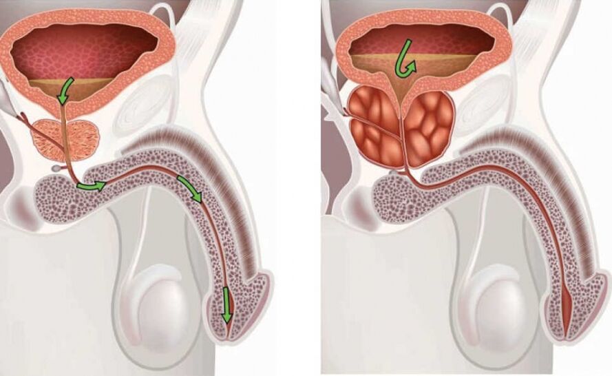 Informationen zur Krankheit Prostatitis. 